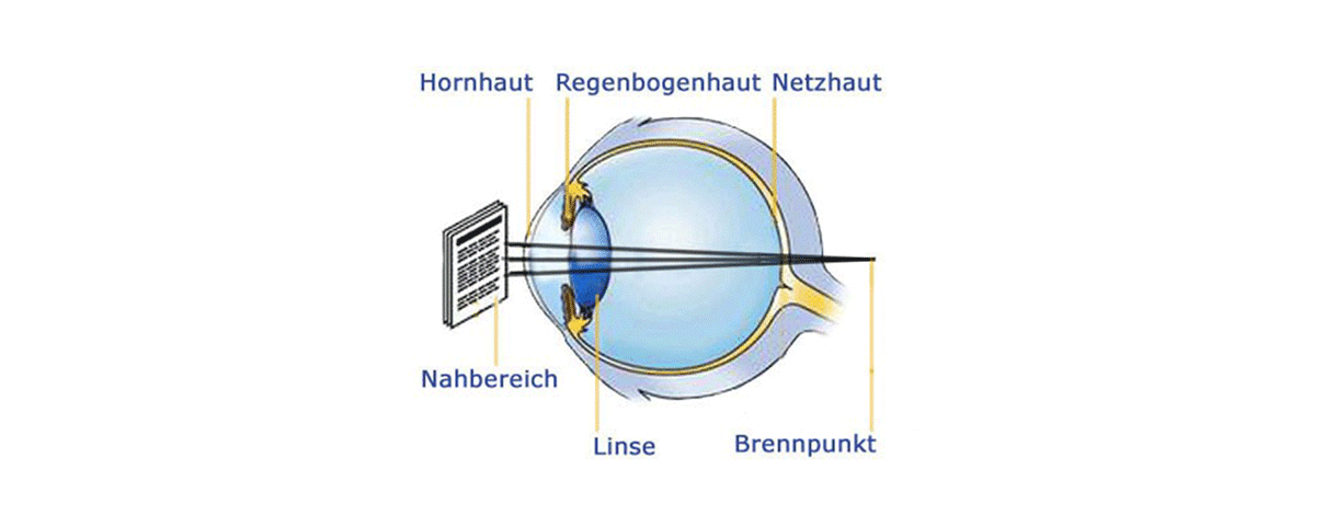 Schema der Alterssichtigkeit (Presbyopie), zeigt Schwierigkeiten beim Fokussieren auf Objekte