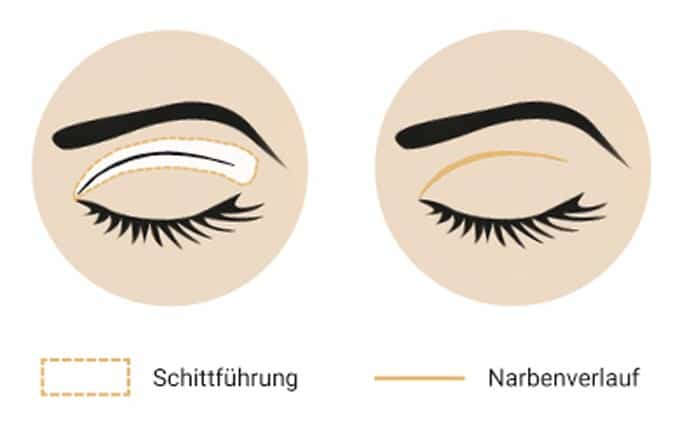 Illustration der Schnittführung und des Narbenverlaufs bei einer Lidstraffung