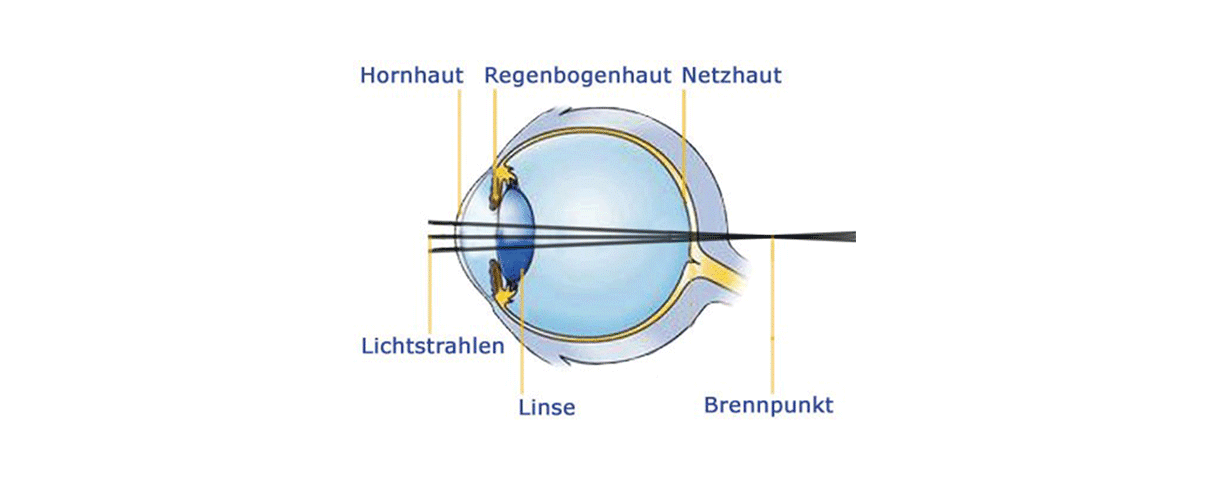 Schema der Weitsichtigkeit (Hyperopie), zeigt Fokuspunkt hinter der Netzhaut
